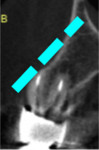 Fig 8. CBCT cross-section view demonstrating that long axes of tooth and alveolar ridge are dissimilar.