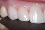 Figure 11  The laboratory fabricated single-unit IPS e.max<sup>®</sup> Press restorations; the patient was very pleased with the final results.