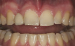 Figure 1  The patient presented with a debonded pontic from a resin-bonded fixed bridge.