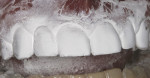 Figure 7  The facial and lingual aspects of the framework were conditioned with CoJet sand in a mini air-abrasion unit.