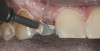 Figure 3  EVALUATION PARAMETERS  The Rule of Thirds: The canal or canal space preparation should not be any wider than one third the mesiodistal root diameter after the endodontic access.