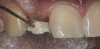 Figure 6  CLINICAL GUIDELINES  If periodontal surgery is chosen to retain the tooth, its affects on adjacent teeth must be taken into consideration.