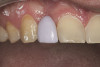 Figure 9  CLINICAL GUIDELINES Narrow vertical defects respond more favorably to regeneration attempts. If periodontal surgery is attempted in the anterior region, the possibility of an esthetic compromise should always be considered regardless of defect morphology.