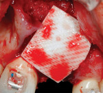 Fig 10. Bone graft was covered with a resorbable cross-link collagen membrane.