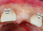 Fig 13 and Fig 14. Flapless implant placement.