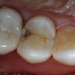 Figure 1  The maxillary first premolar presented with previous direct-composite resin veneering and proximal decay.