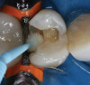 Figure 14  ENDODONTIC AND ESTHETIC PARAMETERS The previous restorations have a height-to-width ratio < 100%.