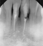Fig 1. Initial presentation. Note large resorptive defect on the distal extent of tooth No. 24.