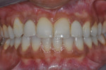 Figure 2  The completed case at 1 year. Note the gingival symmetry created with the use of an anatomically correct surgical template fabricated through crown-down planning after ridge reconstruction of site No. 7 was successfully completed. Screw-ret