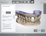 Figure 3  TRIOS’s built-in tools for instant clinical validation help to ensure the high quality of the impression and tooth preparation while the patient is still in the chair. Communication is optimized for sharing case information, with the 3-D