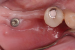 Fig 7. Preoperative view showing condition of soft tissue around implant No. 31.