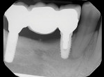 Fig 8. Periapical radiograph of implant-supported screw-retained PFM bridge, Nos. 29 through 31.