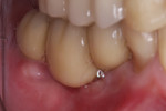 Fig 12. Implant-supported screw-retained PFM bridge, Nos. 29 through 31, postoperative.