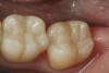 Figure  7  Porcelain-fused-to-metal restorations opposing the natural teeth.