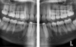 Figure 2  A panoramic bitewing projection demonstrating open contacts and erupting lower third molars. This image was preceded by a conventional panoramic with the patient in the same position; all of the additional structures of interest were imaged