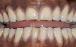 Figure 2  Preoperative view of a male patient with significant tooth wear and flattening of his smile line with obvious esthetic impact.