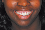 Figure 1  Presentation before cosmetic makeover. Old, bulky, stained, and chipped composites are present on maxillary anterior teeth. Note the "gummy" smile present with a high lip line.