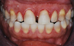Figure 7  Old composite was stripped from the facial of the anterior teeth, revealing dark, banded teeth.