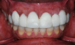 Figure 13  View 2 weeks postsurgery and placement of the functional mock-up. Note the gingival health and lack of inflammation.