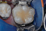 Figure 2g  Repaired surface immediately after treatment.