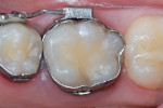 Figure 2h  The dried tooth surface is seen 16 months after repair.