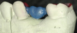 Figure 4  Buccal view of the wax-up.