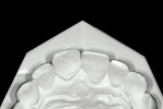 Figure 1d  The lingual surfaces of the maxillary incisors were abraded.