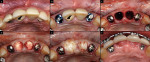Figure 3  The maxillary right and left lateral incisors were extracted, and implants were immediately placed into the extraction sockets without elevating a flap (A,B). Cover screws were placed over the implants and the maxillary central incisors wer