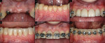 Figure 4  After 6 months, the implants had integrated (A), and the orthodontic brackets were removed to facilitate temporary restoration of the mandibular incisors (B). A provisional bridge was constructed and attached to the maxillary lateral inciso