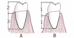 The relationship of the tooth to bone. (A) A healthy periodontal condition showing the ideal crown-to-root ratio; (B) Note the change in the surrounding bone, reflecting a diminished crown-to-root ratio.