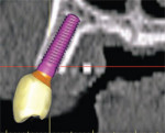 The next level of sophistication combines the implant, the abutment, and the virtual tooth to complete the process of total visualization of the end result.