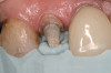 Figure 9  Clinical case of invasive cervical resorption that was deemed nonrestorable and the tooth removed.