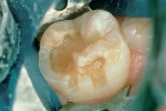 Figure 2b  Tooth preparation for resin-modified glass-ionomer repair.
