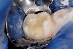 Figure 5b  Molar prepared and dentin replaced with Vitrebond liner.