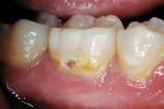 Figure 6a  Caries/decalcification lesion of a permanent molar.