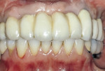 Fig 11. Frontal view after insertion of laboratory-processed maxillary fixed provisional restoration into implants Nos. 2, 3, 4, 13, and 14.