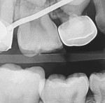 Follow-up occlusal, buccal, and radiographic views acquired 3 years, 11 months, postoperatively.