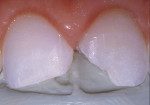 Figure 6  An infinite/virtual bevel was placed to facilitate transitioning of the enamel shade of composite into the remaining tooth structure.
