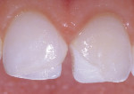 Figure 8  Shade A20 Opaque composite was placed as the lingual enamel layer for both teeth Nos. 8 and 9 to control opacity and eliminate show-through.