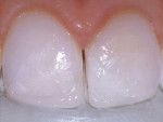 Figure 9  An Extra Bright White (XBW) shade composite was placed along the incisal third of the teeth to create natural-looking variations in shade and chroma.