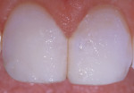 Figure 10  A thick final enamel layer of BW (Bleaching White) composite was placed on the central incisors.
