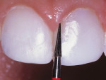 Figure 12  It is beneficial to use a variety of burs and diamonds when contouring and/or gross reduction of the composite resin restorations is performed.