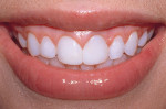Figure 19  Close-up postoperative view of the patient's natural smile.