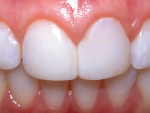 Figure 20  Postoperative 1:1 view of the patient's maxillary central incisors. Note the imperceptible blend of color and morphology with the adjacent natural dentition.