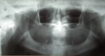 Figure 1  Preliminary panoramic radiograph with markers within a stent to aid in locating the mental foramen.