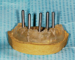 Figure 3  Clear replica of mandibular denture modified as a surgical stent shown with paralleling pins present on a master model.