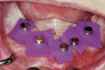 Figure 16  Pieces of non-latex dam were placed over each site to prevent resin entrapment between the soft tissue and the implant during the pickup procedure.
