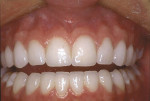 Figure 6  A 3-year postoperative photograph demonstrates excellent esthetic results.