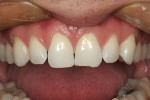 Figure 7  Preoperative view of teeth Nos. 7 through 10 to be considered for veneers.