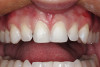 Figure 1  Replacement of a missing tooth has long been a treatment objective to improve oral health and function